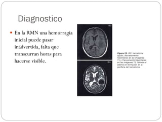Diagnostico
 En la RMN una hemorragia
inicial puede pasar
inadvertida, falta que
transcurran horas para
hacerse visible.
 