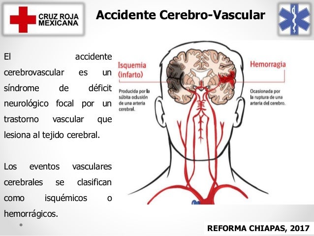 Resultado de imagen para foto del accidente cardiocerebral cerebral