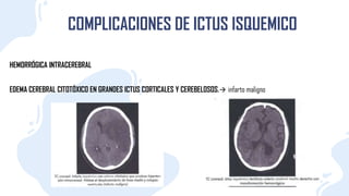 COMPLICACIONES DE ICTUS ISQUEMICO
HEMORRÓGICA INTRACEREBRAL
EDEMA CEREBRAL CITOTÓXICO EN GRANDES ICTUS CORTICALES Y CEREBELOSOS. infarto maligno
 
