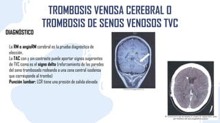 TROMBOSIS VENOSA CEREBRAL O
TROMBOSIS DE SENOS VENOSOS TVC
DIAGNÓSTICO
La RM o angioRM cerebral es la prueba diagnóstica de
elección.
La TAC con y sin contraste puede aportar signos sugerentes
de TVC como es el signo delta (reforzamiento de las paredes
del seno trombosado rodeando a una zona central isodensa
que corresponde al trombo)
Punción lumbar: LCR tiene una presión de salida elevada
 