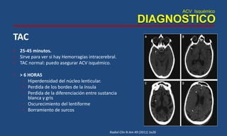 ACV Isquémico
DIAGNOSTICO
TAC
• 25-45 minutos.
• Sirve para ver si hay Hemorragias intracerebral.
• TAC normal: puedo asegurar ACV isquémico.
• > 6 HORAS
– Hiperdensidad del núcleo lenticular.
– Perdida de los bordes de la ínsula
– Perdida de la diferenciación entre sustancia
blanca y gris
– Oscurecimiento del lentiforme
– Borramiento de surcos
Radiol Clin N Am 49 (2011) 1e26
 