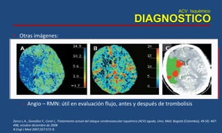 ACV Isquémico
DIAGNOSTICO
• Otras imágenes:
– Angiografía por TAC
– Resonancia Magnética Cerebral
• visualización mas temprana de la isquemia
• Técnica de difusión – perfusión
– Angio – RMN: útil en evaluación flujo, antes y después de trombolisis
Zarco L.A., González F., Coral J., Tratamiento actual del ataque cerebrovascular isquémico (ACV) agudo, Univ. Méd. Bogotá (Colombia), 49 (4): 467-
498, octubre-diciembre de 2008
N Engl J Med 2007;357:572-9.
 Ausencia de señal de flujo en
los vasos arteriales.
 Aumento de señal del
parénquima.
 Edema Cerebral.
 Dilatación Ventricular.
 