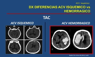 ACV Isquémico
DX DIFERENCIAS ACV ISQUEMICO vs
HEMORRAGICO
Radiol Clin N Am 49 (2011) 1e26
TAC
ACV ISQUEMICO ACV HEMORRAGICO
 La sangre intracerebral aparece como una área de
alta densidad en un primer momento.
 Después disminuye y las lesiones aparecen
eventualmente como isodensas o hipodensas.
 Reducción paulatina de la densidad y pérdida de
la definición de los contornos
 Hematomas Intracraneales.
 El TAC en la fase hiperaguda de un ACV
isquémico es frecuentemente normal.
> 6 HORAS
 Hiperdensidad del núcleo lenticular.
 Perdida de los bordes de la ínsula.
 Perdida de la diferenciación entre
sustancia blanca y gris.
 Oscurecimiento del lentiforme.
 Perdida de los limites de los núcleos de la
base.
 Borramiento de surcos
 