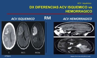 ACV Isquémico
DX DIFERENCIAS ACV ISQUEMICO vs
HEMORRAGICO
Radiol Clin N Am 49 (2011) 1e26
RMACV ISQUEMICO ACV HEMORRAGICO
 Edema cerebral.
 Desplazamiento de las estructuras de la línea
media por el edema cerebral asociado.
 Dilatación ventricular.
 Desmielinización de la sustancia blanca del
cerebro. Se observa zona hiperintensa en T2, de
aspecto parcheado y localización periventricular o
subcortical.
 Gliosis: Zona del cerebro con tono negro,
semejante al líquido cefalorraquídeo por la
ausencia de señal que indica infarto isquémico
antiguo.
 Focos Hemorrágicos.
 El hematoma tiende a ser isointenso con el
parénquima en T1 e hiperintenso en T2
 