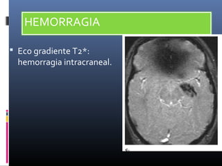 Accidente Cerebrovascular isquemico | PPT
