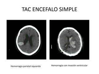 TAC ENCEFALO SIMPLE 
Hemorragia parietal izquierda Hemorragia con invasión ventricular 
 