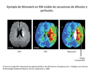 Ejemplo de Mismatch en RM visible de secuencias de difusión y 
perfusión. 
El ictus en el siglo XXI. Tratamiento de urgencia Stroke in the XXI Century. Emergency care. J. Gállego, y col. Servicio 
de Neurología Hospital de Navarra. Vol.31, suplemento 1, 2008. 
 