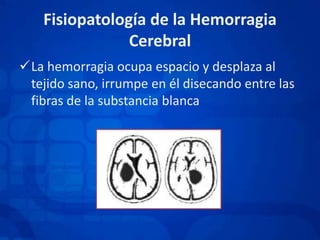 Fisiopatología de la HemorragiaCerebralLa hemorragia ocupa espacio y desplaza al tejido sano, irrumpe en él disecando entre las fibras de la substancia blancaFisiopatología de la HemorragiaCerebralEl déficit clínico es secundario de  al menos de cuatro factores:Efecto de masa y los desplazamientos del tejido cerebral-hernias