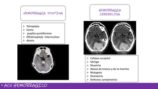• ACV HEMORRAGICO
HEMORRAGIA PONTINA
HEMORRAGIA
CEREBELOSA
 Tetraplejia
 Coma
 pupilas puntiformes
 Oftalmoplejia internuclear
 Ataxia
 Cefalea occipital
 Vértigo
 Disartria
 Ataxia de tronco y de la marcha
 Nistagmo
 Disimetría
 Defectos campimetría
 