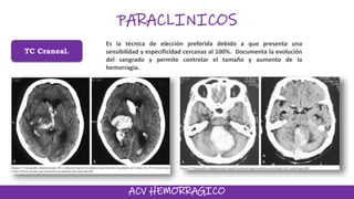 TC Craneal.
Es la técnica de elección preferida debido a que presenta una
sensibilidad y especificidad cercanas al 100%. Documenta la evolución
del sangrado y permite controlar el tamaño y aumento de la
hemorragia.
PARACLINICOS
ACV HEMORRAGICO
 
