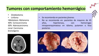 Tumores con comportamiento hemorrágico
• Glioblastoma
• Linfoma
•Metástasis Melanoma
40% Coriocarcinoma
60% Adenocarcinoma
renal Carcinoma
broncógeno
¿Se recomienda Angiografía?
• Se recomienda en pacientes jóvenes
• No se recomienda en: pacientes de mayores de 45
años, hipertensos, con hemorragia
intraparenquimatosa en tálamo, putamen o fosa
posterior.
 