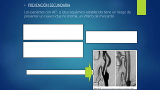 • PREVENCIÓN SECUNDARIA
Los pacientes con AIT o ictus isquémico establecido tiene un riesgo de
presentar un nuevo ictus no mortal, un infarto de miocardio
- Tto y control de los factores de
riesgo vascular: LDL <100mg/dl, se
recomienda administración de estatinas. - Antiagregantes plaquetarios:
Aspirina 100 a 300 mg/día;
clopidogrel 75 mg/dia
- Anticoagulantes : Se inicia con heparina
endovenosa en dosis de 400 UI/kg
peso/dia con controles de TTPa a la
6horasde inicio de perfusión
- Endarterectomía o angioplastia carótideas
 