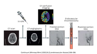 Continuum (Minneap Minn) 2020;26 (2,cerebrovascular disease):268–286.
 
