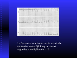 La frecuencia ventricular media se calcula
contando cuantos QRS hay durante 6
segundos y multiplicando x 10.
 