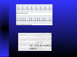 AC x FA de conduccion aberrante
(HBA)
 