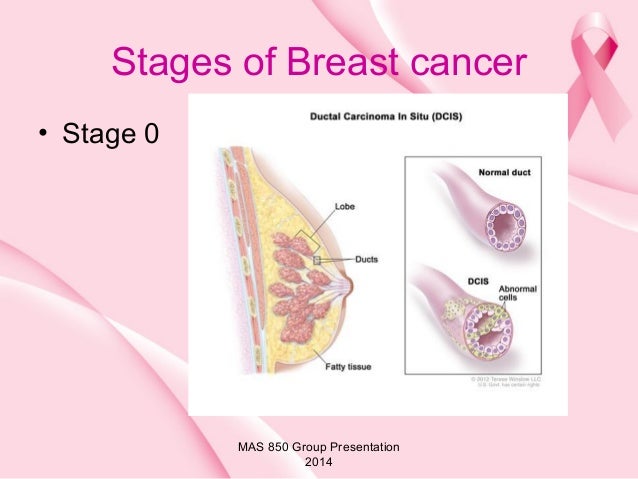 Overview of Breast cancer