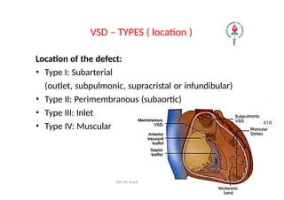 Subaortic Ridge Types ACYANOTIC CONGENITAL HEART DISEASE-ATRIAL SEPTAL DEFECT (ASD) | PPTX