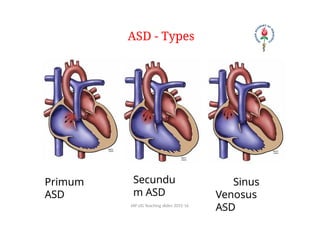 ACYANOTIC CONGENITAL HEART DISEASE-ATRIAL SEPTAL DEFECT (ASD) | PPTX