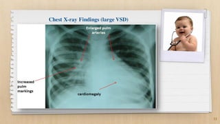 33
Chest X-ray Findings (large VSD)
 