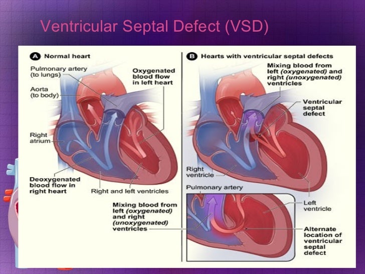 Acyanotic Heart Defects