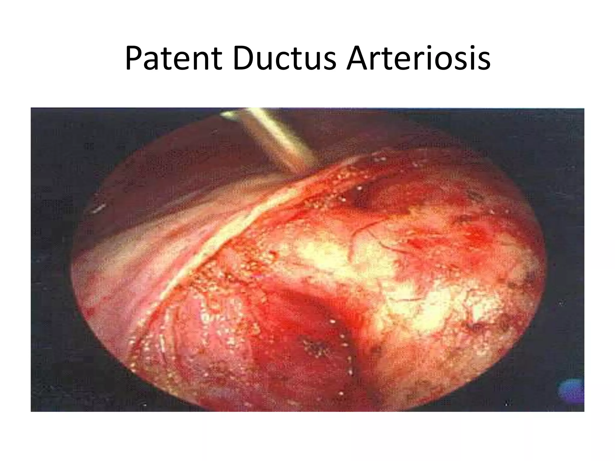 Patent Ductus Arteriosis
 