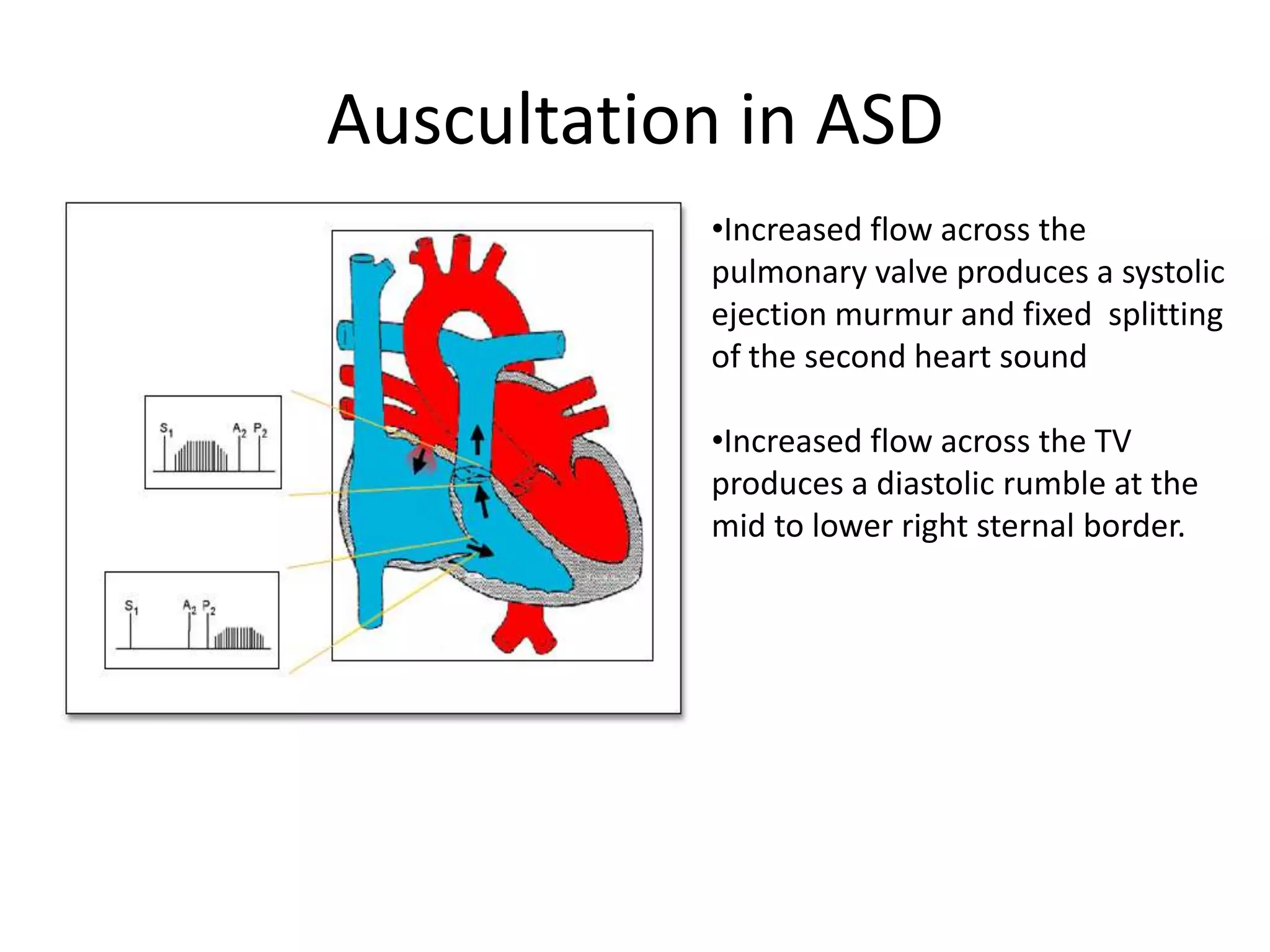 Auscultation in ASD
           •Increased flow across the
           pulmonary valve produces a systolic
           ejection murmur and fixed splitting
           of the second heart sound

           •Increased flow across the TV
           produces a diastolic rumble at the
           mid to lower right sternal border.
 