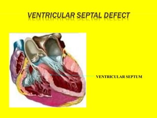 VENTRICULAR SEPTUM
 