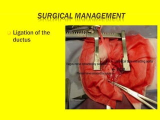 ❑ Ligation of the
ductus
 