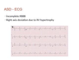 A-cynotic Heart diseases of pediatrics population. | PPTX