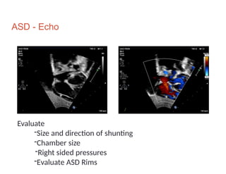 A-cynotic Heart diseases of pediatrics population. | PPTX