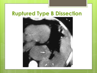 Aortic Disssection. Dr Nikrish Hegde. | PPTX