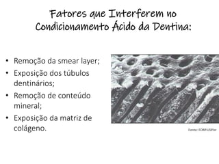 Fatores que Interferem no
Condicionamento Ácido da Dentina:
• Remoção da smear layer;
• Exposição dos túbulos
dentinários;
• Remoção de conteúdo
mineral;
• Exposição da matriz de
colágeno. Fonte: FORP.USP.br
 