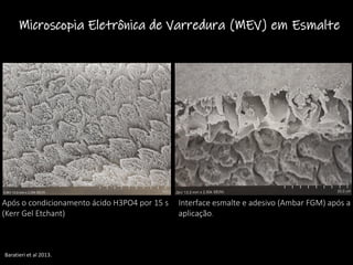 Após o condicionamento ácido H3PO4 por 15 s
(Kerr Gel Etchant)
Interface esmalte e adesivo (Ambar FGM) após a
aplicação.
Microscopia Eletrônica de Varredura (MEV) em Esmalte
Baratieri et al 2013.
 