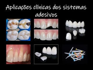 Aplicações clínicas dos sistemas
adesivos
 