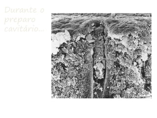 Durante o
preparo
cavitário...
Formação de:
➢Smear layer
➢Smear plug
➢Lama
dentinária
 