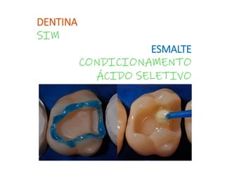 DENTINA
SIM
ESMALTE
CONDICIONAMENTO
ÁCIDO SELETIVO
 