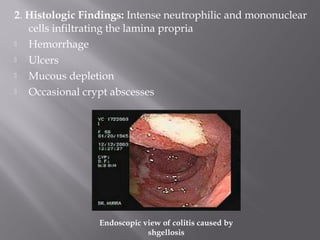 2. Histologic Findings: Intense neutrophilic and mononuclear
   cells infiltrating the lamina propria
  Hemorrhage
  Ulcers
  Mucous depletion
  Occasional crypt abscesses




                 Endoscopic view of colitis caused by
                             shgellosis
 