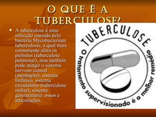 O que é a tuberculose? A tuberculose é uma infecção causada pelo bactéria Mycobacterium tuberculosis, a qual mais comumente afeta os pulmões (tuberculose pulmonar), mas também pode atingir o sistema nervoso central (meningite), sistema linfático, sistema circulatório (tuberculose miliar), sistema geniturinário, ossos e articulações. 