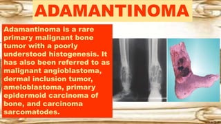 ADAMANTINOMA
Adamantinoma is a rare
primary malignant bone
tumor with a poorly
understood histogenesis. It
has also been referred to as
malignant angioblastoma,
dermal inclusion tumor,
ameloblastoma, primary
epidermoid carcinoma of
bone, and carcinoma
sarcomatodes.
 