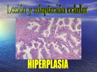Lesión y adaptación celular HIPERPLASIA 