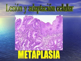 Lesión y adaptación celular METAPLASIA