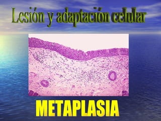 Lesión y adaptación celular METAPLASIA