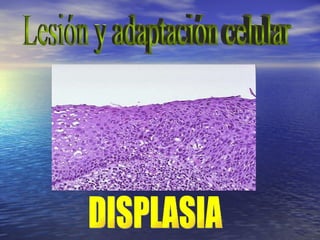 Lesión y adaptación celular DISPLASIA