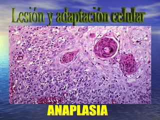 Lesión y adaptación celular ANAPLASIA