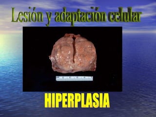 Lesión y adaptación celular HIPERPLASIA