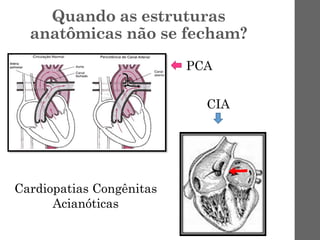 Quando as estruturas
anatômicas não se fecham?
Cardiopatias Congênitas
Acianóticas
PCA
CIA
 