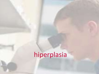 hiperplasia
 