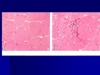 ATROFIA
Atrofia glandular
prostática: epitelio
glandular prostático
aplanado, (H&E).
 