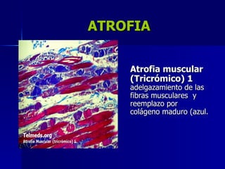 ATROFIA
ATROFIA
Atrofia muscular
Atrofia muscular
(Tricrómico) 1
(Tricrómico) 1
adelgazamiento de las
adelgazamiento de las
fibras musculares y
fibras musculares y
reemplazo por
reemplazo por
colágeno maduro (azul.
colágeno maduro (azul.
 