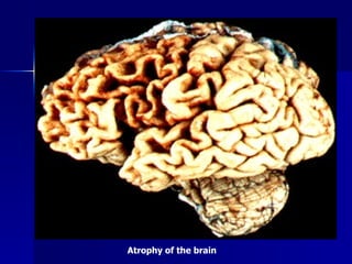 Atrophy of the brain
 